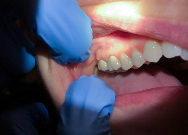 Best Broken or Cracked Tooth Emergency Dentist in Veazie, ME
